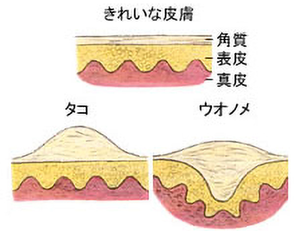 タコ・ウオノメでお悩みの方