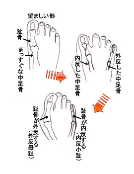 外反母趾・内反小趾の原因